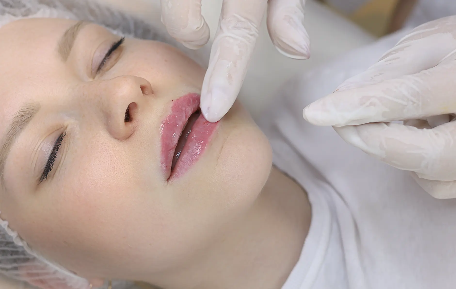 ¿Qué es la queiloplastía o cirugía de labios?